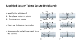 Modified Kessler Tajima Suture (Strickland)
• Modified by addition of
 Peripheral epitenon suture
 Core mattress suture
• Knots are tied within the tendon
• Sutures are locked with each exit from
the tendon.
 