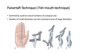 Pulvertaft Technique ( Fish mouth technique)
• Commonly used to suture tendons of unequal size
• Tendon of small diameter can be sutured to one of large diameter
 