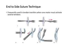 End to Side Suture Technique
• Frequently used in tendon transfers when one motor must activate
several tendons
 