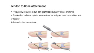 Tendon to Bone Attachment
• Frequently requires a pull-out technique (usually distal phalanx)
• For tendon to bone repairs ,core suture techniques used most often are
Kessler
Bunnell crisscross suture
 