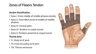 Zones of Flexors Tendon
Verdan Classification
• Zone I: From middle of middle phalanx distally
• Zone II: From MCP joints to middle of middle
phalanx
• Zone III: Central palm
• Zone IV: Tendons in carpal tunnel
• Zone V: Tendons proximal to carpal tunnel
Thumb Zone
• TI: Distal to IP joint
• TII: From A1 pulley to IP joint
• TIII: Thenar eminence
 