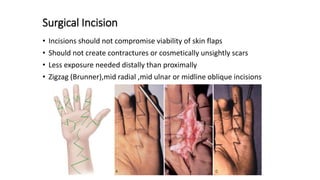 Surgical Incision
• Incisions should not compromise viability of skin flaps
• Should not create contractures or cosmetically unsightly scars
• Less exposure needed distally than proximally
• Zigzag (Brunner),mid radial ,mid ulnar or midline oblique incisions
 