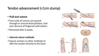 Tendon advancement (<1cm stump)
• Pull-out suture
Free ends of sutures are passed
through or around distal phalanx, tied
over dorsum of fingernail with button.
Removed after 6 weeks
• Internal suture methods
Suture anchors or other methods to
affix the tendon directly to the bone
 