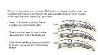 When the diagnosis of interruption of FDP tendon is delayed, and the tendon has
retracted into the palm, its vinculum has been disrupted and a decision must be
made regarding repair depending upon types
• Type I: FDP tendon is avulsed from its
insertion and retracts into palm
• Type II: Avulsed from its insertion but
stump remains within digital sheath
• Type III: Avulsed bony fragment attached
to tendon stump, remains within flexor
sheath
 