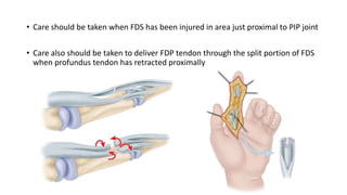 • Care should be taken when FDS has been injured in area just proximal to PIP joint
• Care also should be taken to deliver FDP tendon through the split portion of FDS
when profundus tendon has retracted proximally
 
