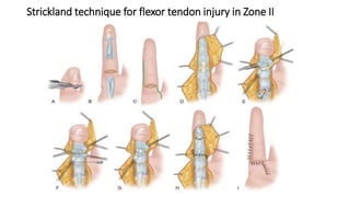 Strickland technique for flexor tendon injury in Zone II
 
