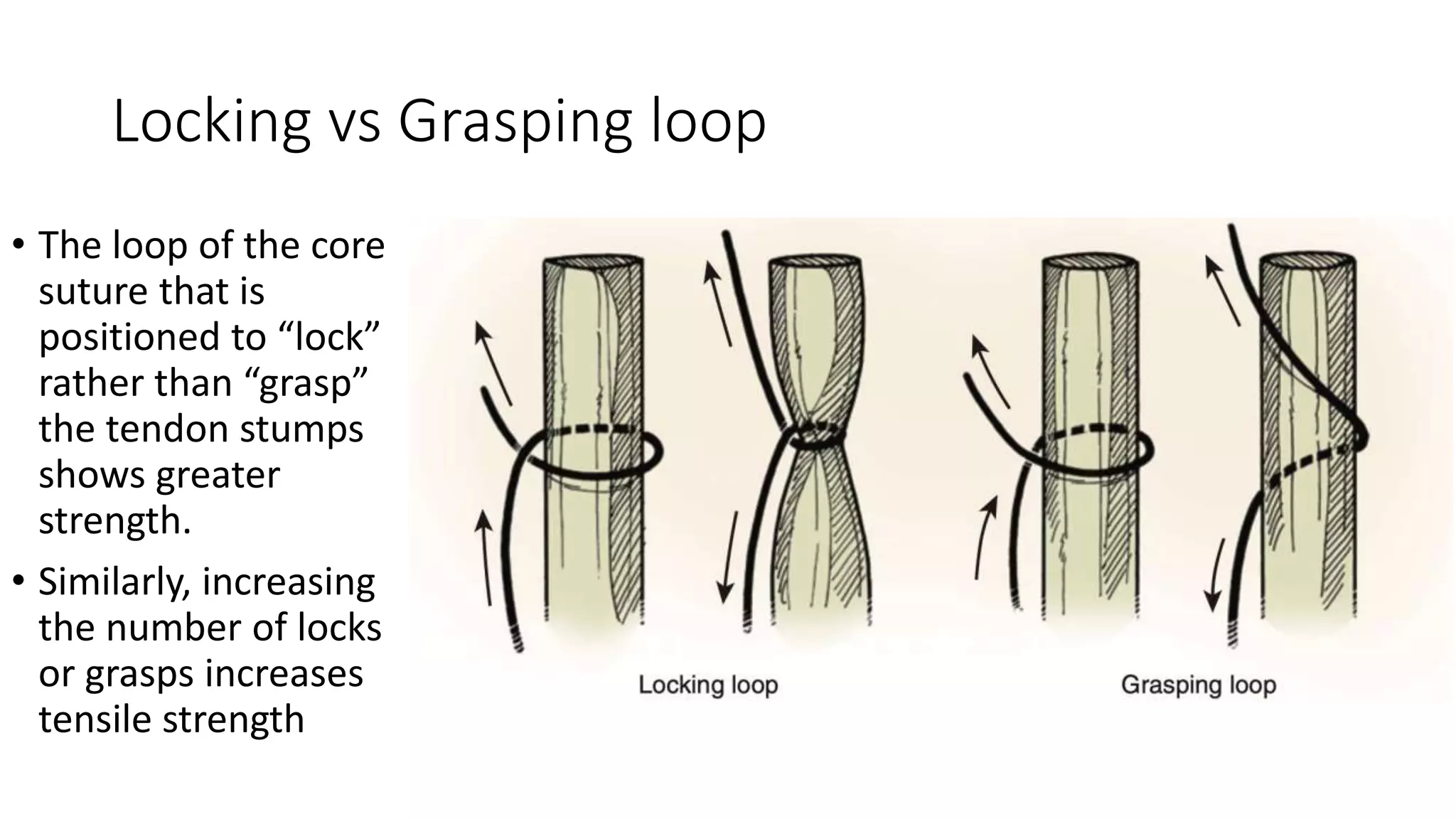 Locking vs Grasping loop
• The loop of the core
suture that is
positioned to “lock”
rather than “grasp”
the tendon stumps
shows greater
strength.
• Similarly, increasing
the number of locks
or grasps increases
tensile strength
 