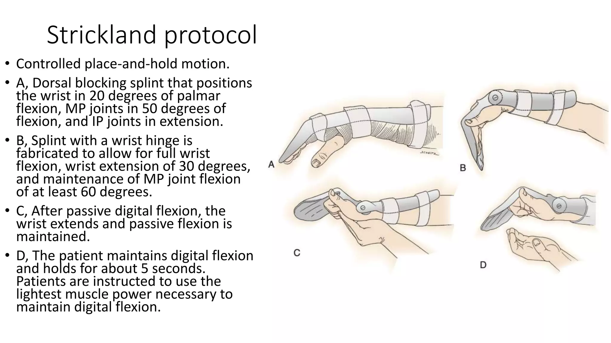 Strickland protocol
• Controlled place-and-hold motion.
• A, Dorsal blocking splint that positions
the wrist in 20 degrees of palmar
flexion, MP joints in 50 degrees of
flexion, and IP joints in extension.
• B, Splint with a wrist hinge is
fabricated to allow for full wrist
flexion, wrist extension of 30 degrees,
and maintenance of MP joint flexion
of at least 60 degrees.
• C, After passive digital flexion, the
wrist extends and passive flexion is
maintained.
• D, The patient maintains digital flexion
and holds for about 5 seconds.
Patients are instructed to use the
lightest muscle power necessary to
maintain digital flexion.
 