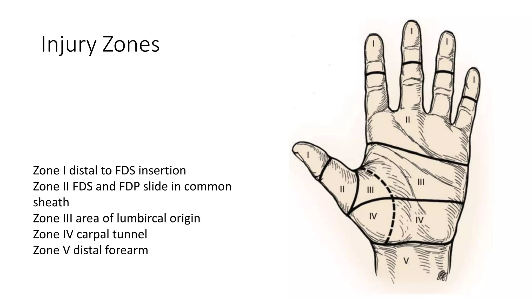 Injury Zones
Zone I distal to FDS insertion
Zone II FDS and FDP slide in common
sheath
Zone III area of lumbircal origin
Zone IV carpal tunnel
Zone V distal forearm
 