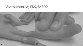 Assessment: A; FDS, B; FDP
 