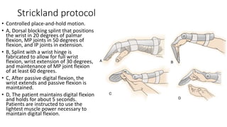 Strickland protocol
• Controlled place-and-hold motion.
• A, Dorsal blocking splint that positions
the wrist in 20 degrees of palmar
flexion, MP joints in 50 degrees of
flexion, and IP joints in extension.
• B, Splint with a wrist hinge is
fabricated to allow for full wrist
flexion, wrist extension of 30 degrees,
and maintenance of MP joint flexion
of at least 60 degrees.
• C, After passive digital flexion, the
wrist extends and passive flexion is
maintained.
• D, The patient maintains digital flexion
and holds for about 5 seconds.
Patients are instructed to use the
lightest muscle power necessary to
maintain digital flexion.
 