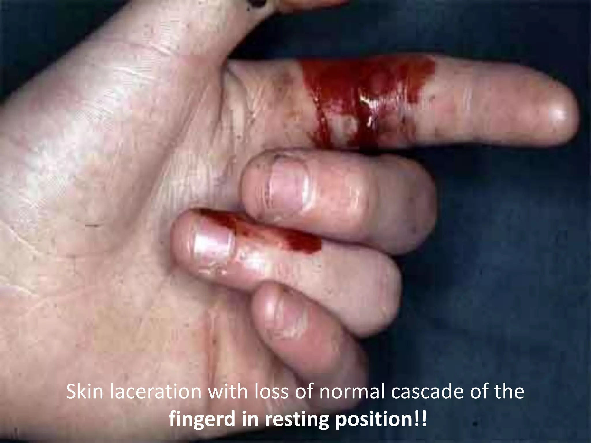 Skin laceration with loss of normal cascade of the
           fingerd in resting position!!
 