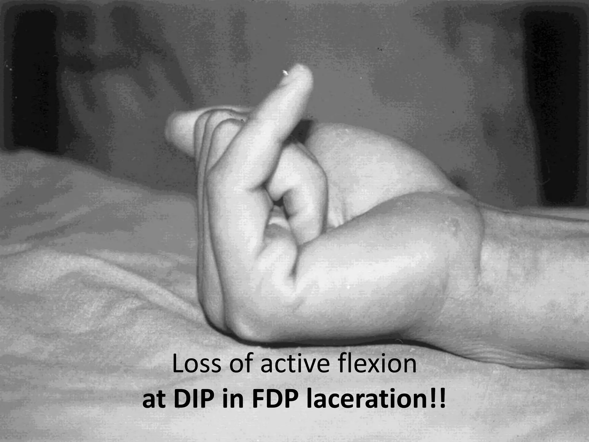 Loss of active flexion
at DIP in FDP laceration!!
 