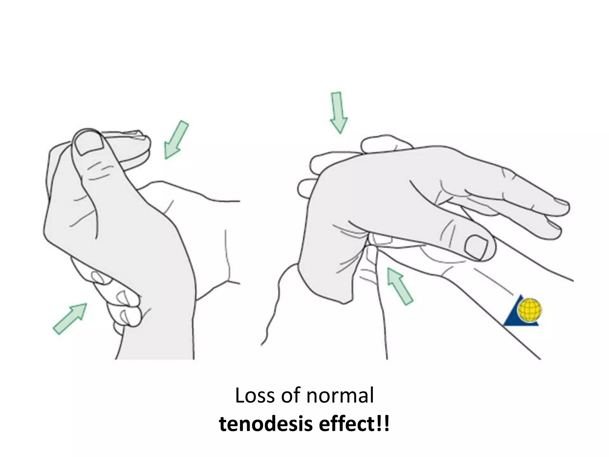 Loss of normal
tenodesis effect!!
 