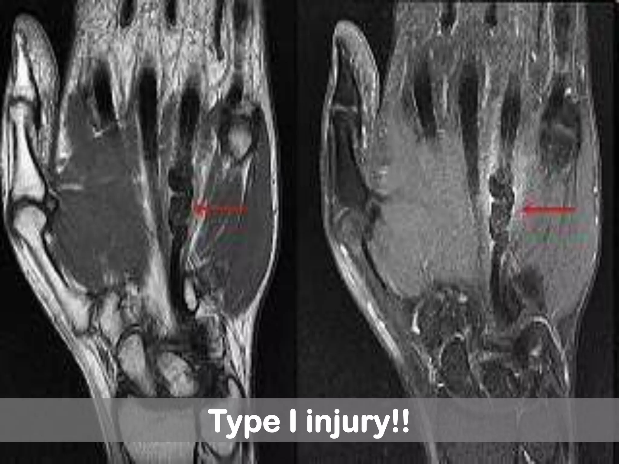 Type I injury!!
 