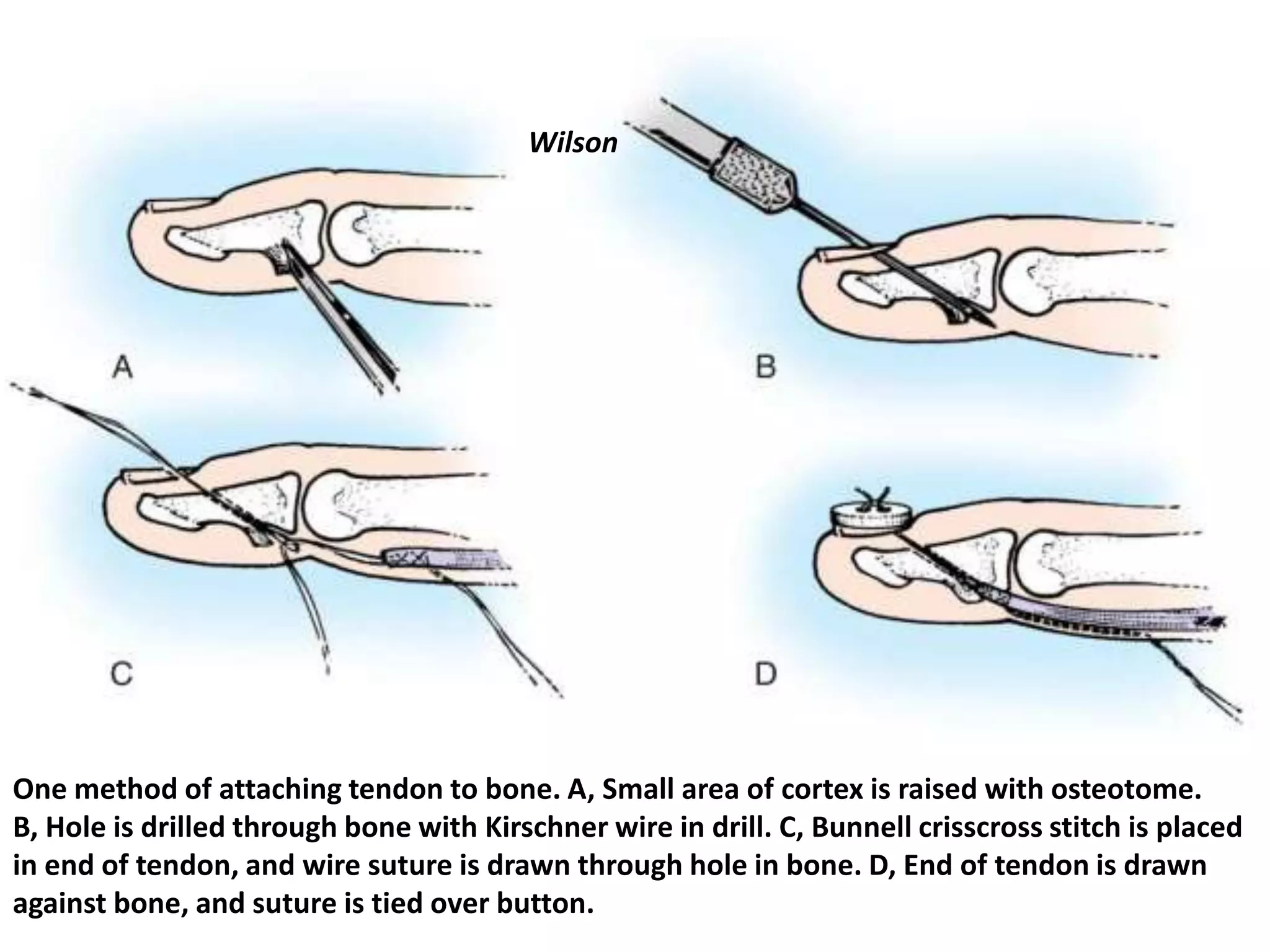 Wilson




One method of attaching tendon to bone. A, Small area of cortex is raised with osteotome.
B, Hole is drilled through bone with Kirschner wire in drill. C, Bunnell crisscross stitch is placed
in end of tendon, and wire suture is drawn through hole in bone. D, End of tendon is drawn
against bone, and suture is tied over button.
 