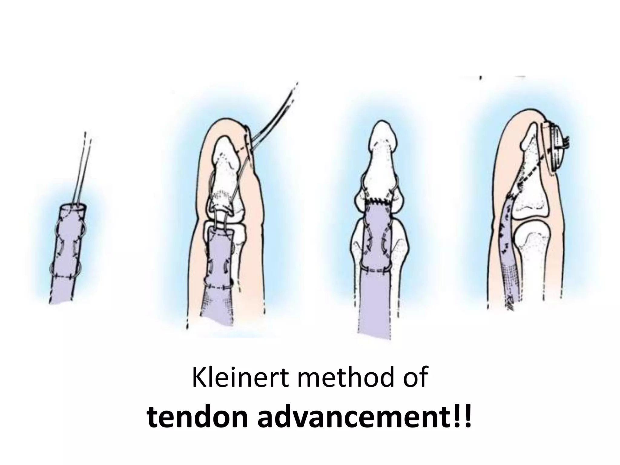 Kleinert method of
tendon advancement!!
 