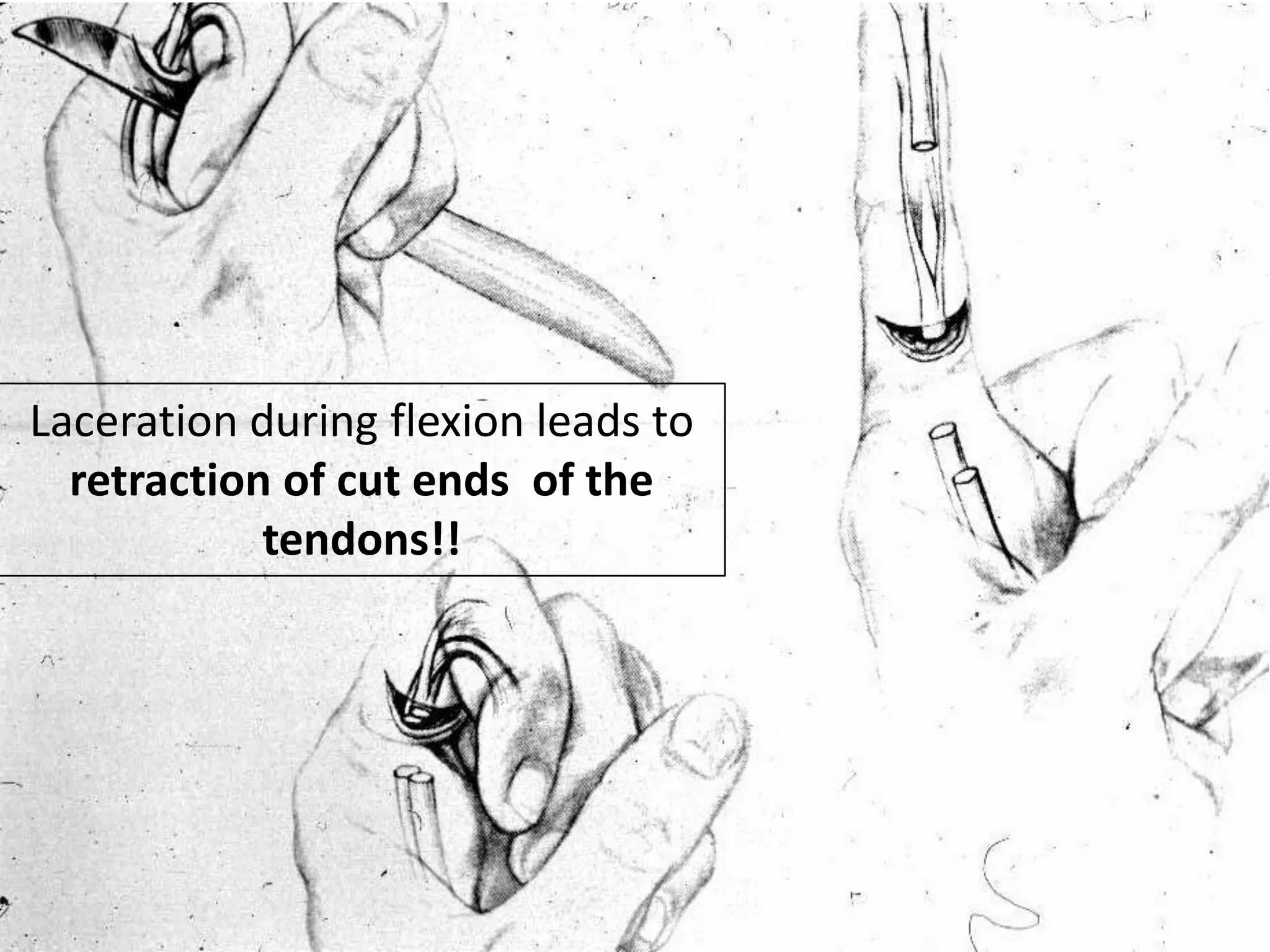 Laceration during flexion leads to
  retraction of cut ends of the
            tendons!!
 