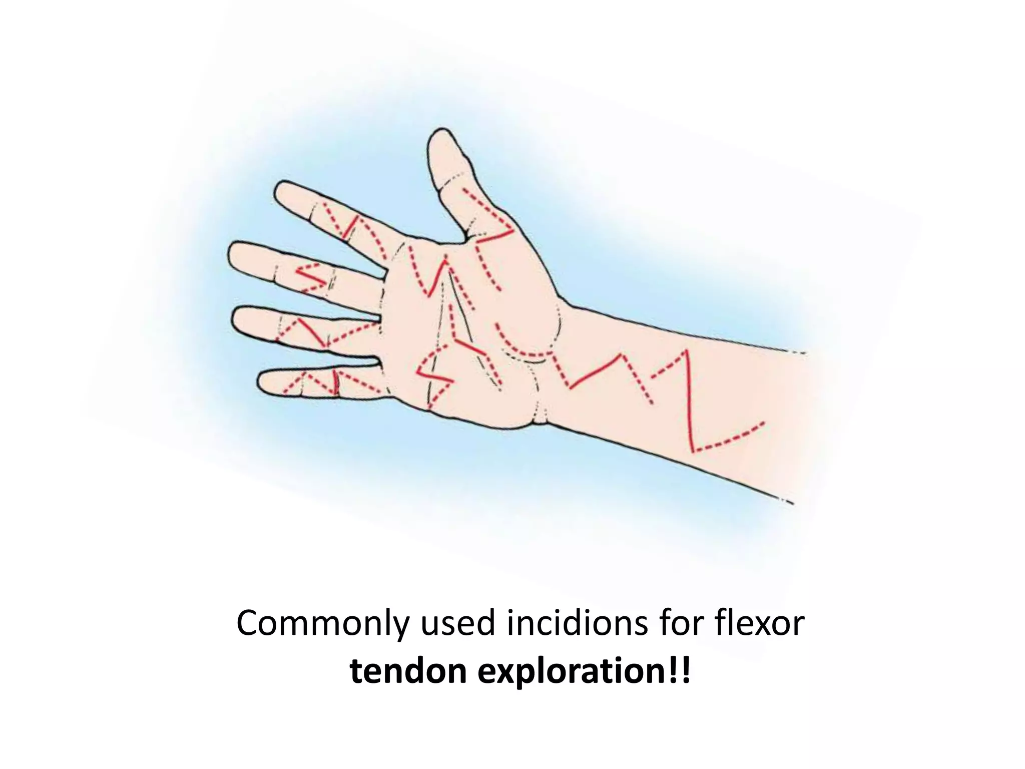 Commonly used incidions for flexor
    tendon exploration!!
 