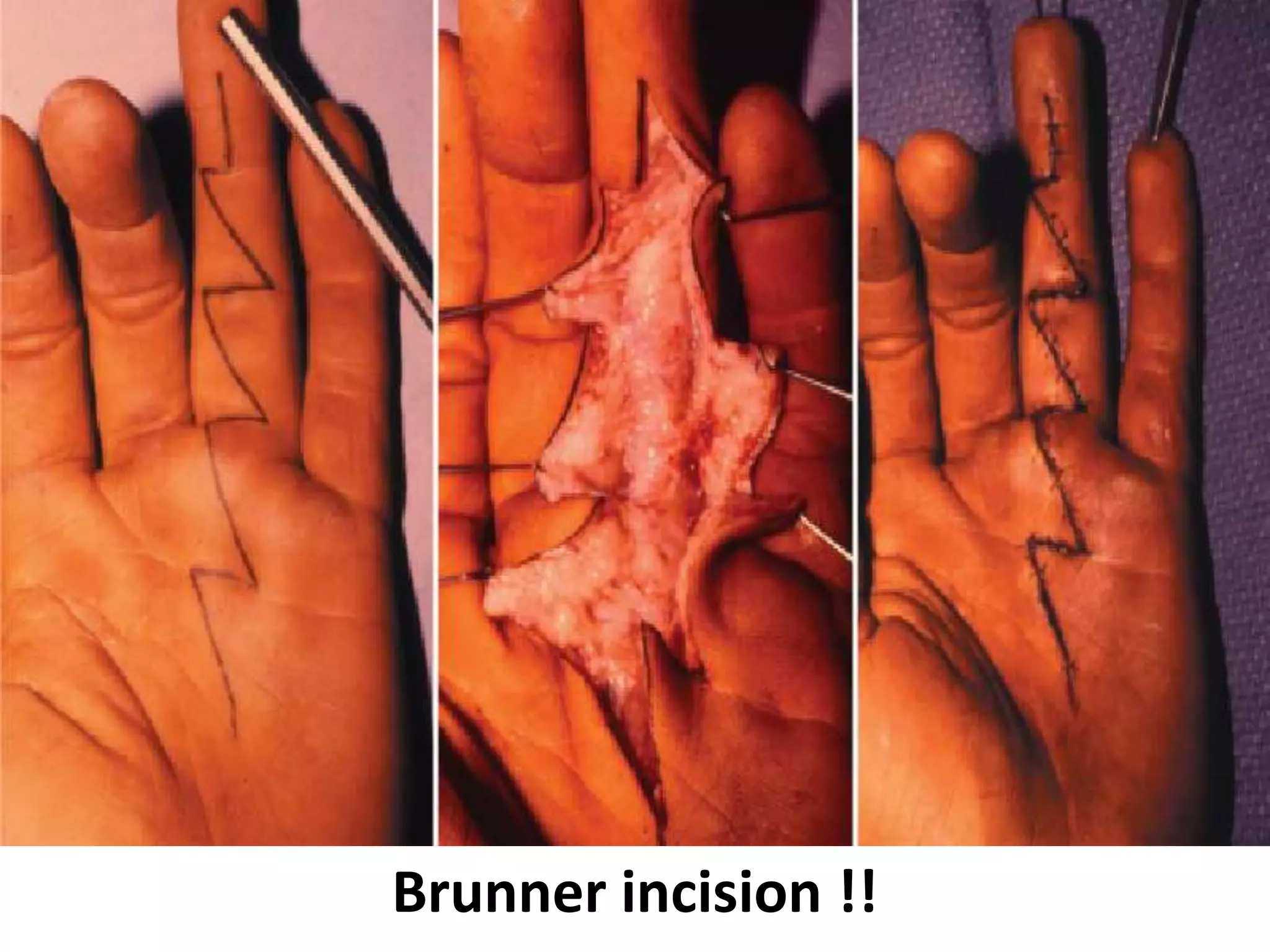 Brunner incision !!
 