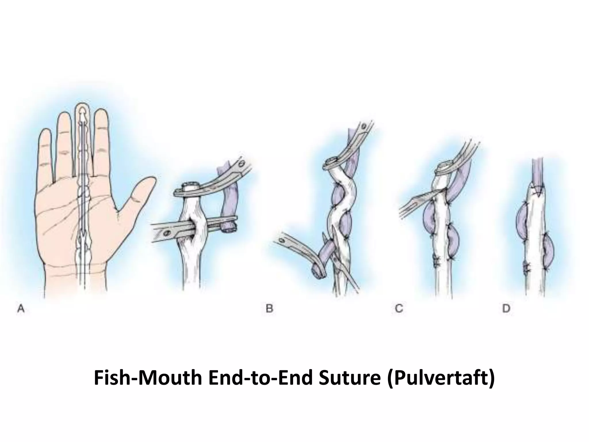 Fish-Mouth End-to-End Suture (Pulvertaft)
 