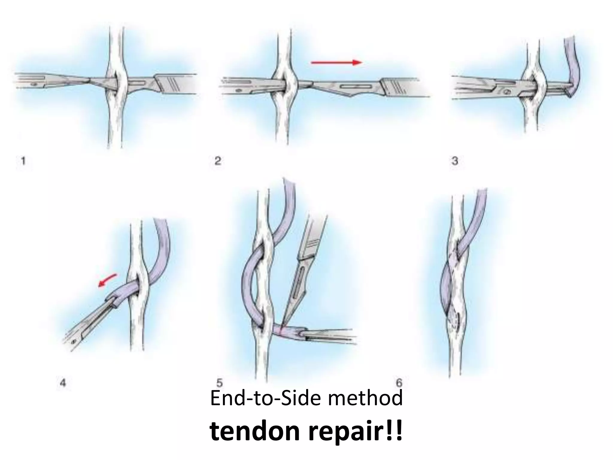 End-to-Side method
tendon repair!!
 