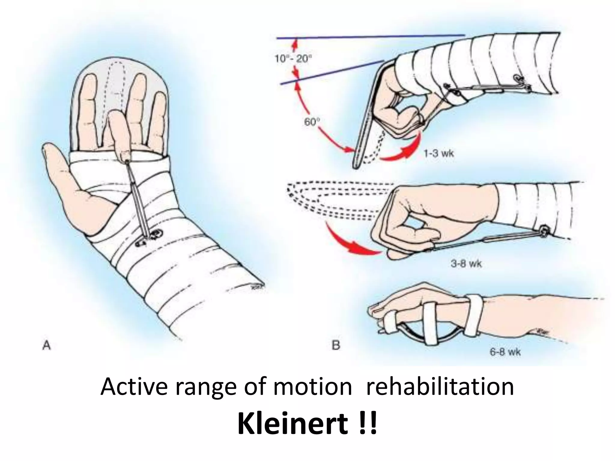 Active range of motion rehabilitation
            Kleinert !!
 