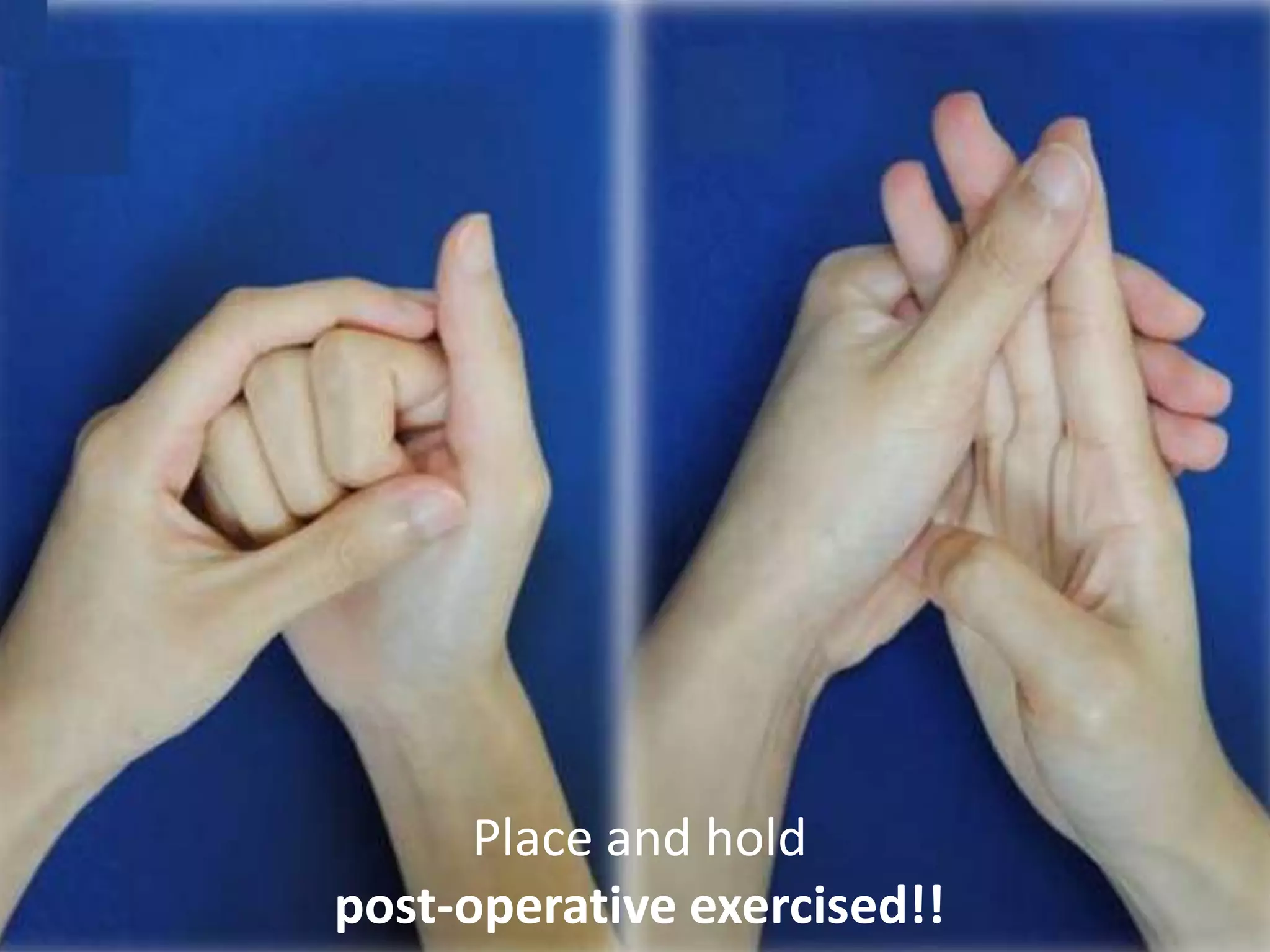 Place and hold
post-operative exercised!!
 