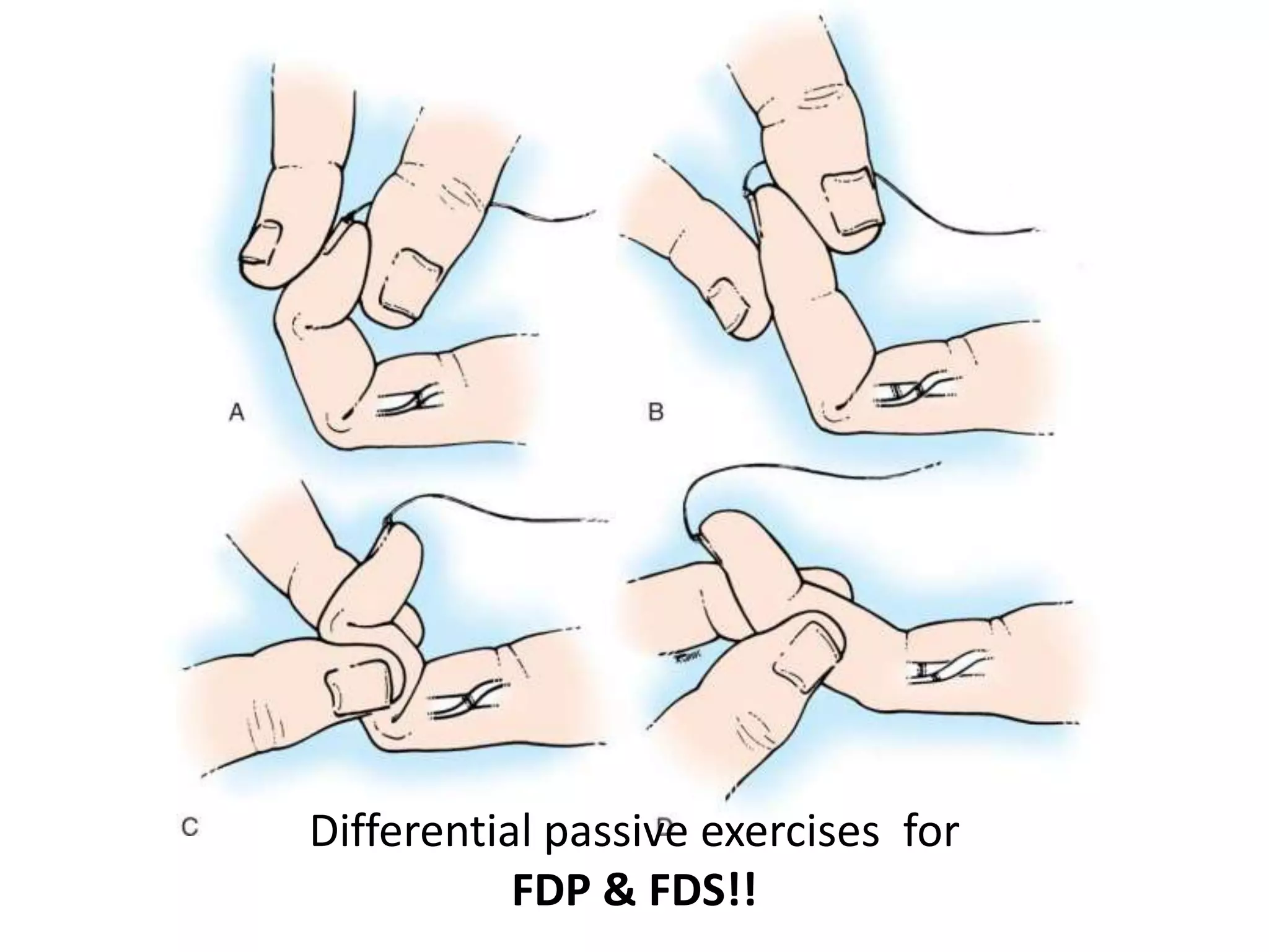 Differential passive exercises for
           FDP & FDS!!
 