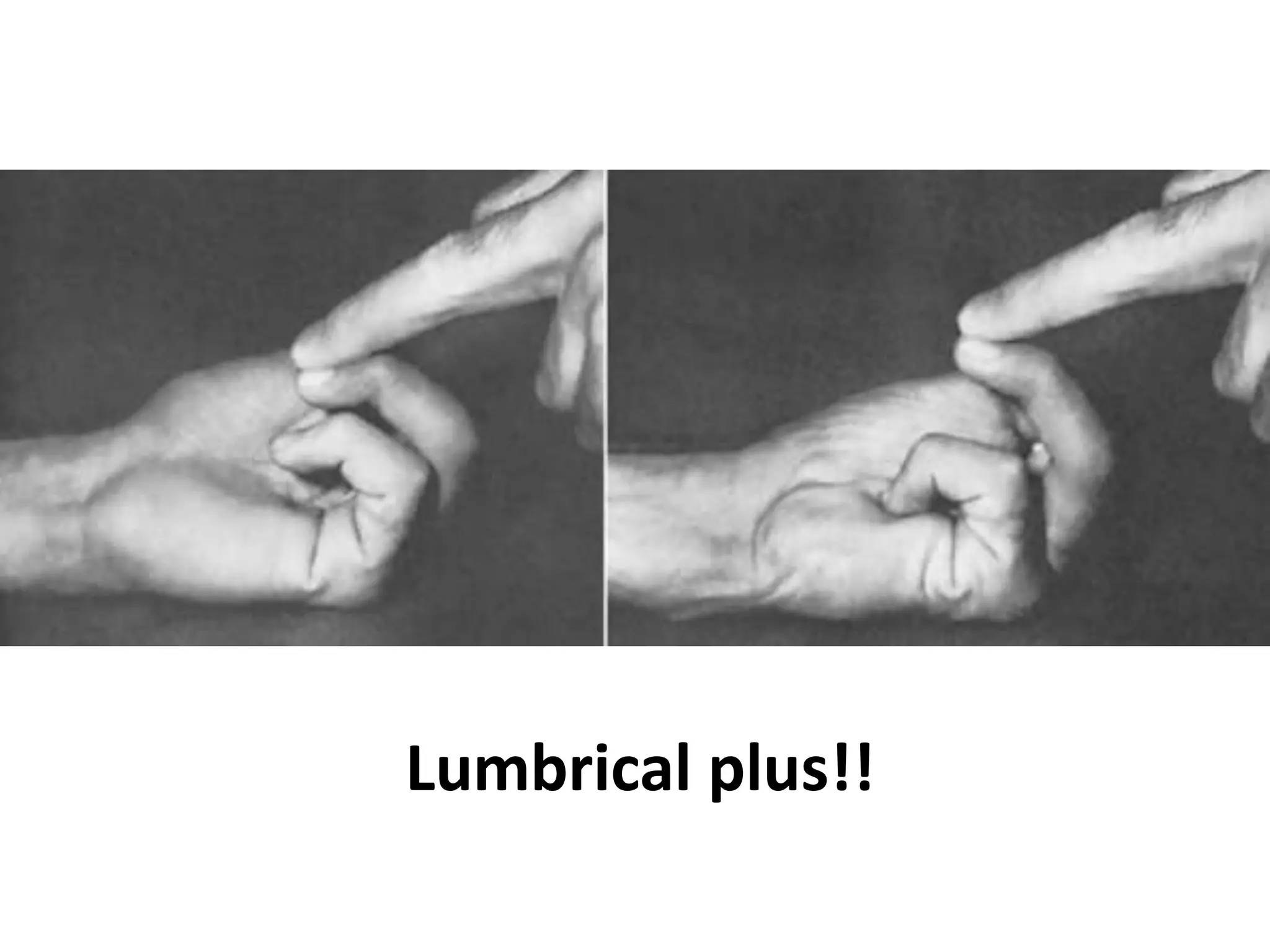 Lumbrical plus!!
 