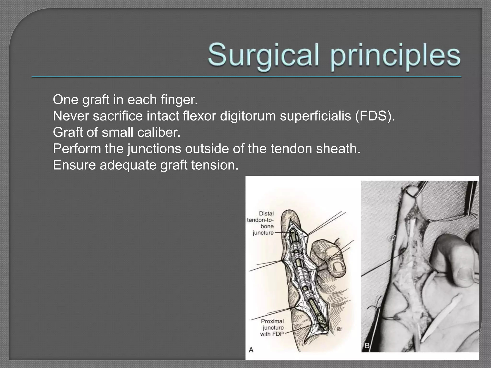 Fds Injuries Flexor tendon injury | PPTX