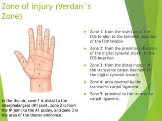 Verdan Classification Flexor tendon injury final edit with pictures | PPTX
