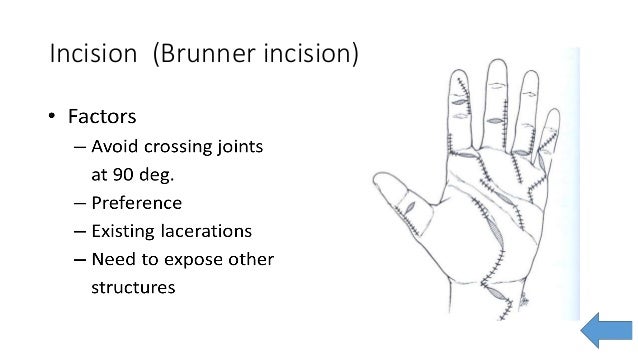 brunner type incision