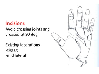 Incisions
Avoid crossing joints and
creases at 90 deg.
Existing lacerations
-zigzag
-mid lateral
 