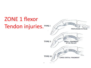 ZONE 1 flexor
Tendon injuries.
 