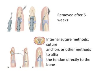 Removed after 6
weeks
Internal suture methods:
suture
anchors or other methods
to affix
the tendon directly to the
bone
 