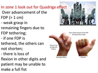 In zone 1 look out for Quadriga effect
Over advancement of the
FDP (> 1 cm)
- weak grasp in
remaining fingers due to
FDP tethering;
- if one FDP is
tethered, the others can
not shorten;
- there is loss of
flexion in other digits and
patient may be unable to
make a full fist
 