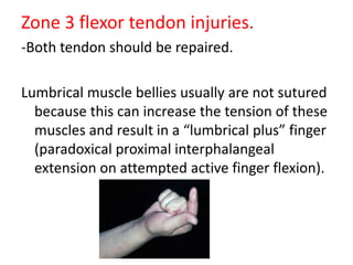 Zone 3 flexor tendon injuries.
-Both tendon should be repaired.
Lumbrical muscle bellies usually are not sutured
because this can increase the tension of these
muscles and result in a “lumbrical plus” finger
(paradoxical proximal interphalangeal
extension on attempted active finger flexion).
 