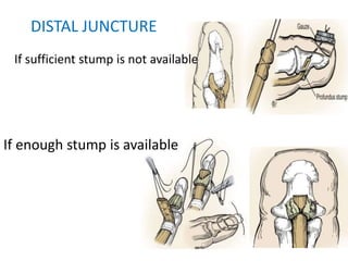 DISTAL JUNCTURE
If enough stump is available
If sufficient stump is not available
 