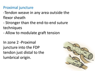 Proximal juncture
-Tendon weave in any area outside the
flexor sheath
- Stronger than the end-to-end suture
techniques
- Allow to modulate graft tension
In zone 2 -Proximal
juncture into the FDP
tendon just distal to the
lumbrical origin.
 