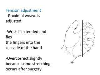 Tension adjustment
-Proximal weave is
adjusted.
-Wrist is extended and
flex
the fingers into the
cascade of the hand
-Overcorrect slightly
because some stretching
occurs after surgery
 
