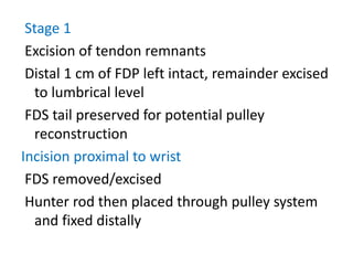 Stage 1
Excision of tendon remnants
Distal 1 cm of FDP left intact, remainder excised
to lumbrical level
FDS tail preserved for potential pulley
reconstruction
Incision proximal to wrist
FDS removed/excised
Hunter rod then placed through pulley system
and fixed distally
 