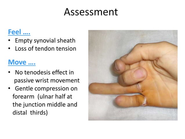 Tendon Testing Hand Flexor tendon surgery Review | PPTX