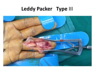 Leddy Packer Type III
 