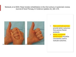 Neiduski, et al 2019. Flexor tendon rehabilitation in the 21st century: A systematic review.
Journal of Hand Therapy, SI: Evidence Updates 32, 165–174.
• Place and hold exercises
provide better outcomes
than passive flexion
protocols
• Active, functional
performance should be
consistently used to
evaluate outcomes.
 