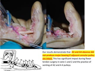 Our results demonstrate that A2 and A4 absence did
not produce major bowing if adjacent annular pulley
are intact. This has significant impact during flexor
tendon surgery in zone 1 and 2 and the practice of
venting of A2 and A 4 pulleys.
 