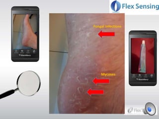 Fungal Infections
Mycoses
 