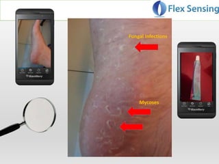 Fungal Infections
Mycoses
 