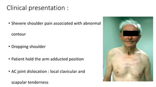 Clinical presentation :
• Shevere shoulder pain associated with abnormal
contour
• Dropping shoulder
• Patient hold the arm adducted position
• AC joint dislocation : local clavicular and
scapular tenderness
 