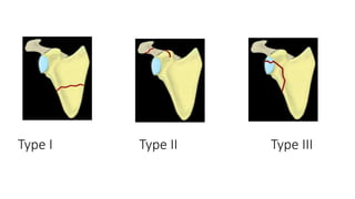 Type I Type II Type III
 